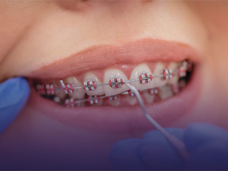 ‘Diş teli’ tedavisinde yaş sınırı var mı?