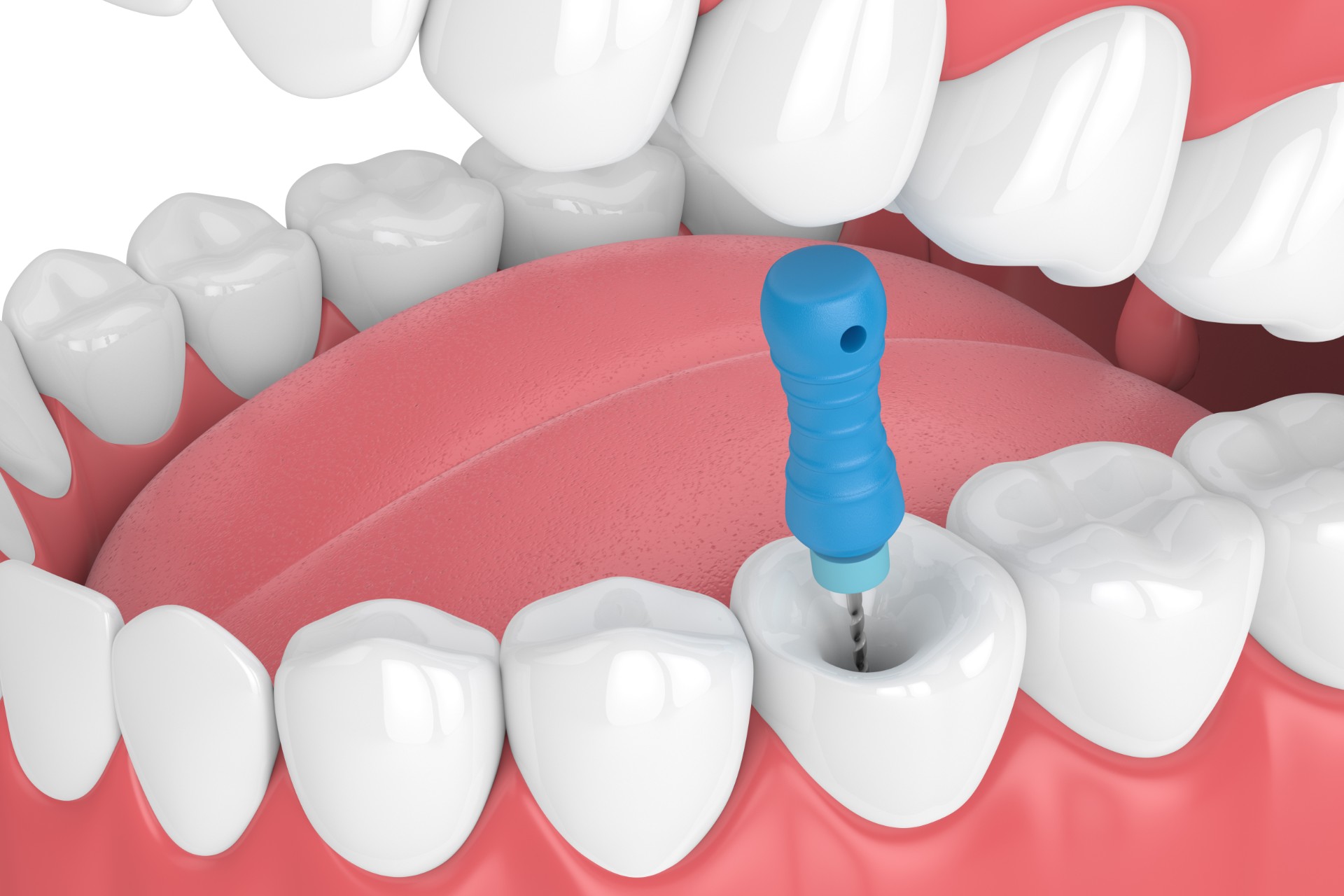 Dental İmplant