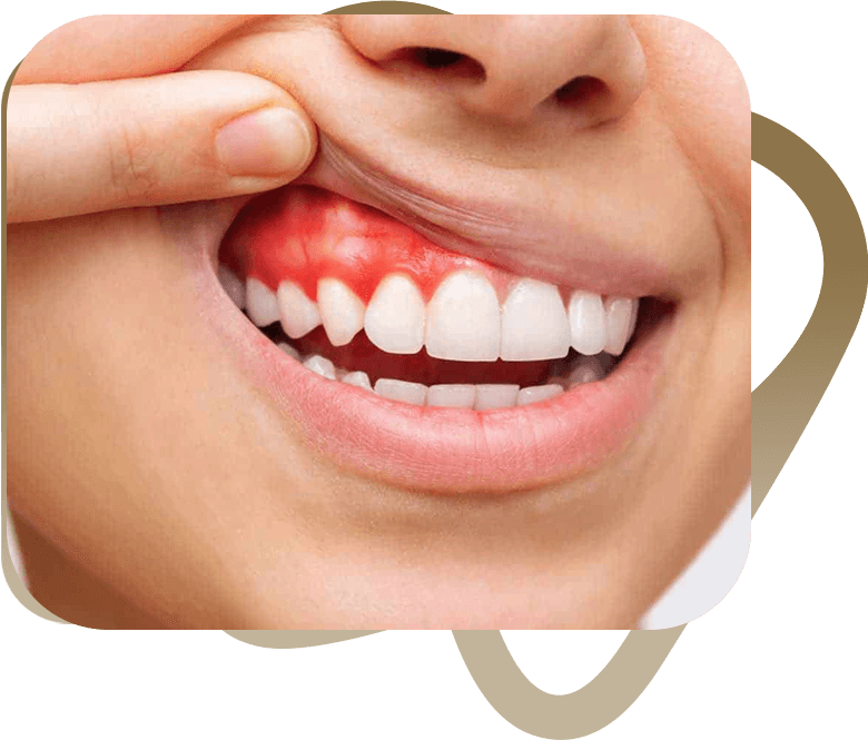 علاج زراعة الأسنان في طرابزون